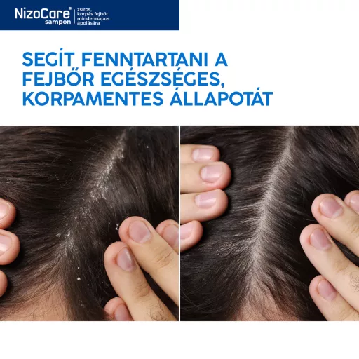 NizoCare sampon zsíros, korpás fejbőr mindennapos ápolására 200 ml